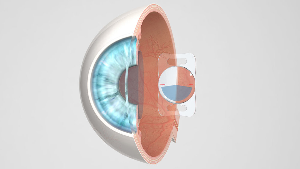 Lentis-MPlus-Lens-Implant